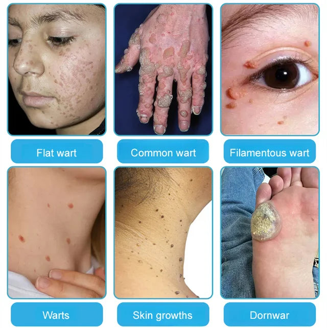 Cryotherapy Spray🌬️Instant cooling relief—say goodbye to discomfort, hello to comfort!