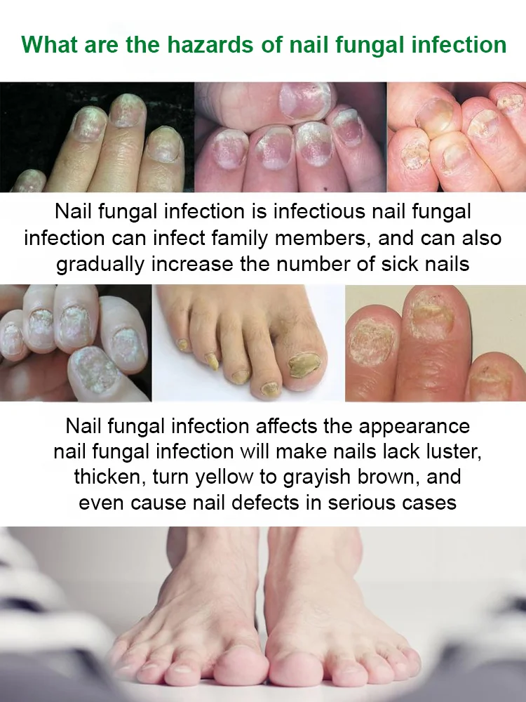 [Nail Care Solution]Professional Nail Repair Solution – Strengthen & Restore Nails