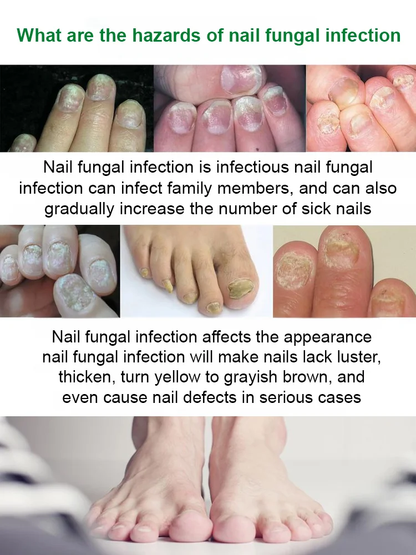 [Nail Care Solution]Professional Nail Repair Solution – Strengthen & Restore Nails