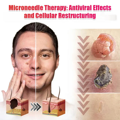 【Quick wart removal patch】plant-based wart removal