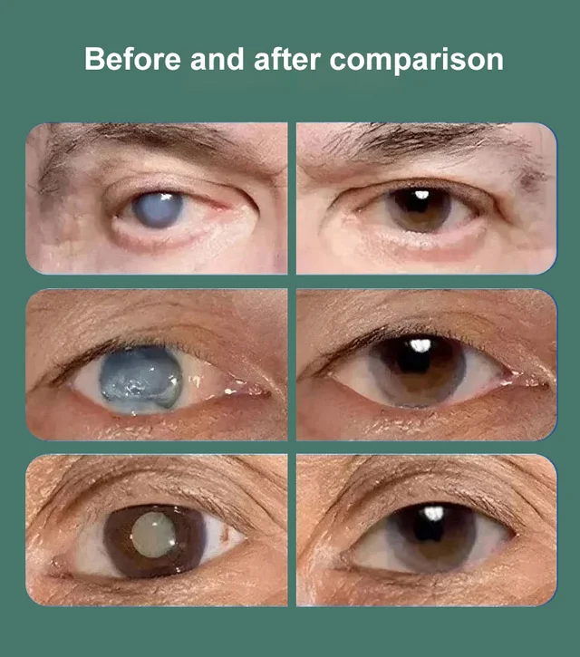【Say Goodbye to Cataracts】Give You Clear Eyes