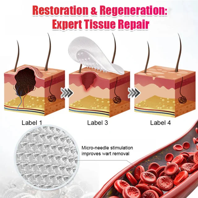 【Quick wart removal patch】plant-based wart removal