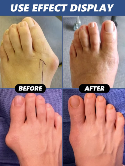 [No surgery required] Hallux valgus corrector