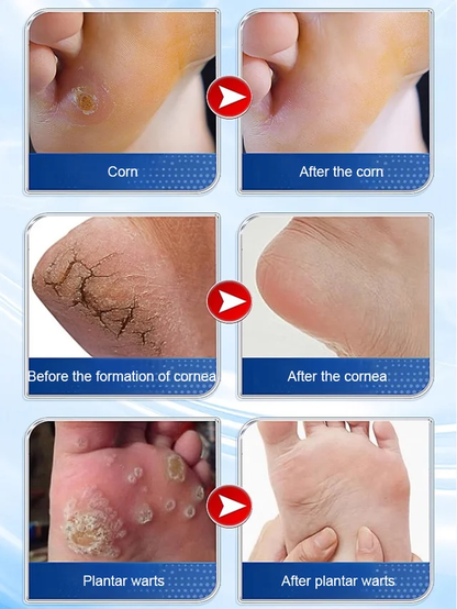 7 Days Pain-Free Herbal Cocoon Removal Cream