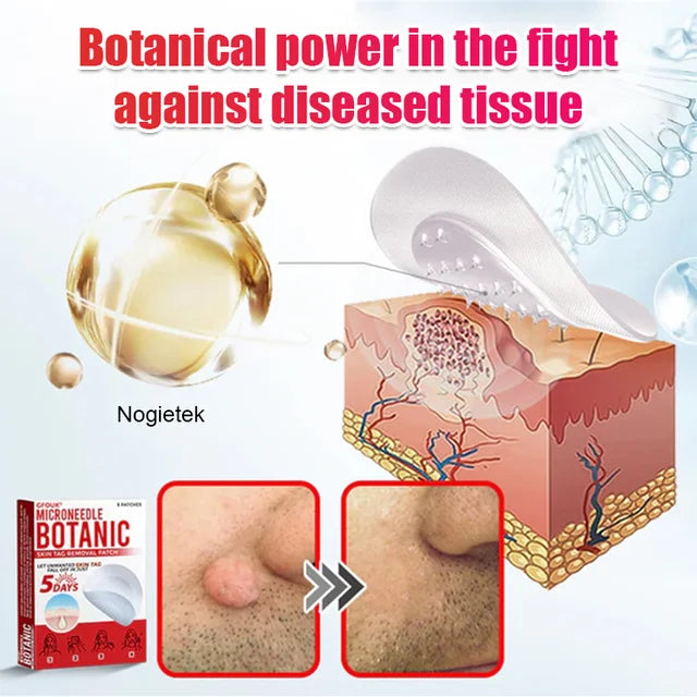 【Quick wart removal patch】plant-based wart removal