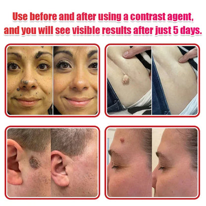 【Quick wart removal patch】plant-based wart removal