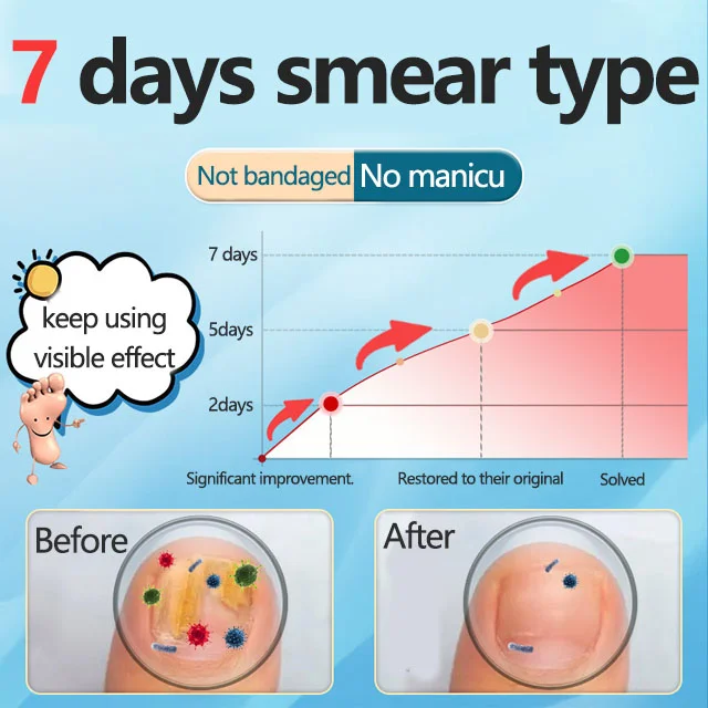 ⏰LAST DAY🔥BUY 1 GET 1 FREE🎁Nail repair pen