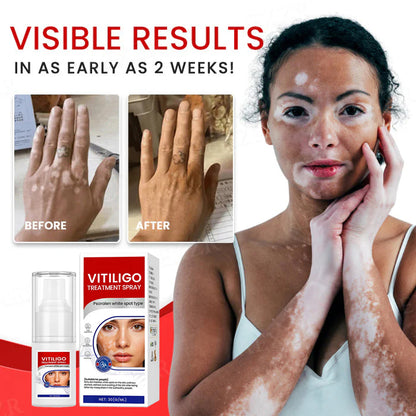 💥Hot Listing🔥Vitiligo Treatment Spray