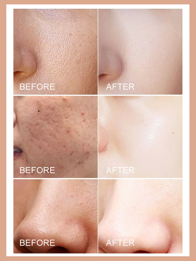 [Washes away 99.9% of dust mites] Salicylic acid soap