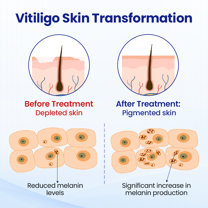 💥Hot Listing🔥Vitiligo Treatment Spray