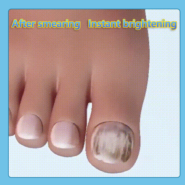 ⏰LAST DAY🔥BUY 1 GET 1 FREE🎁Nail repair pen