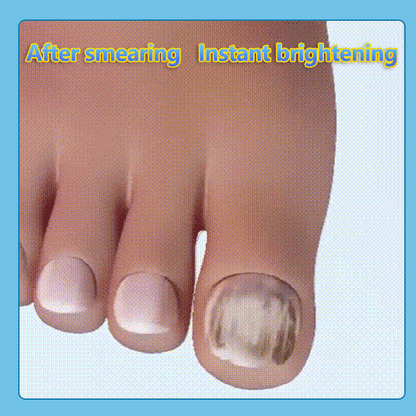 ⏰LAST DAY🔥BUY 1 GET 1 FREE🎁Nail repair pen