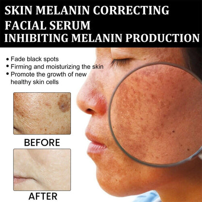 ✨Fast Dark Spot Remover-YIRANTIAN Melanin Correcting Facial Serum
